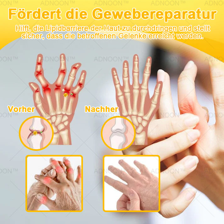 30upsell💧🐝ADNOON™ Magnesiumöl & Bienengift Gelenkheilungsspray 🏅👨‍⚕️